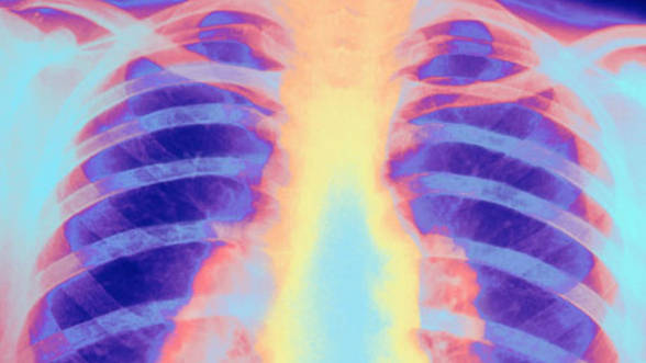 Ziua Mondială de Luptă Împotriva Tuberculozei, în Gorj