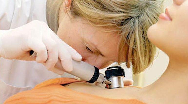 Viaţa sănătoasă – Când devin alunițele motiv de îngrijorare?