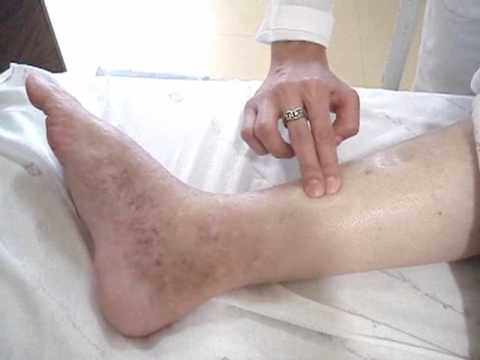 Viaţa sănătoasă – Când apar și cum ameliorăm varicele?