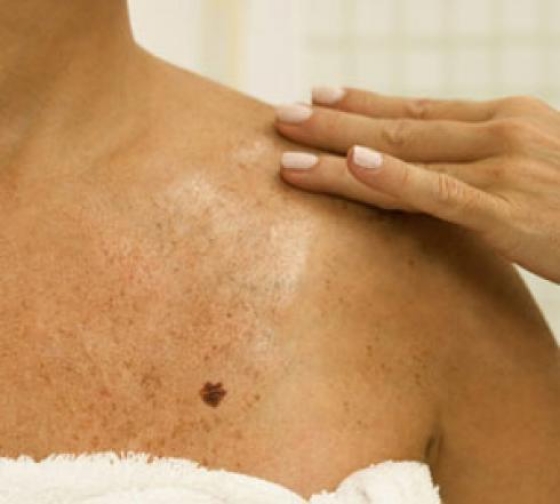 Peste trei sute de gorjeni au cancer de piele