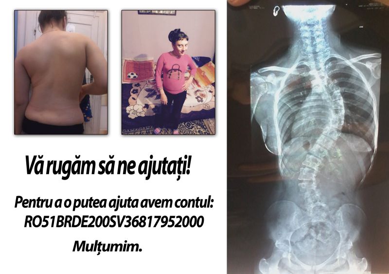 Risc major de paralizie! – O adolescentă din Prigoria are nevoie de 16.000 euro pentru o operație urgentă la coloana vertebrală