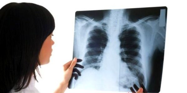 Peste 600 de gorjeni suferă de cancer bronhopulmonar