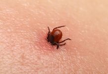 Primul ajutor în cazul înțepăturii de căpușă