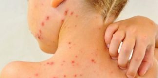 Noi cazuri de rujeolă, confirmate în mai multe județe