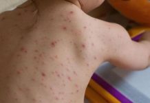 Aproape treizeci de cazuri noi de rujeolă, confirmate în ultima săptămână