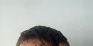 Medicul radiolog de la SJU a repetat examinarea pentru tânărul agresat! De data aceasta, diagnosticul a fost FRACTURĂ de piramidă nazală