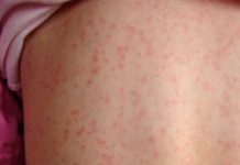 Creștere alarmantă a cazurilor de rujeolă