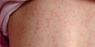 Creștere alarmantă a cazurilor de rujeolă