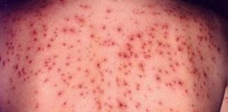 85 de noi cazuri de rujeolă, dintre care unul fiind confirmat în Gorj