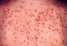 Încă 12 cazuri de rujeolă, confirmate la nivelul țării