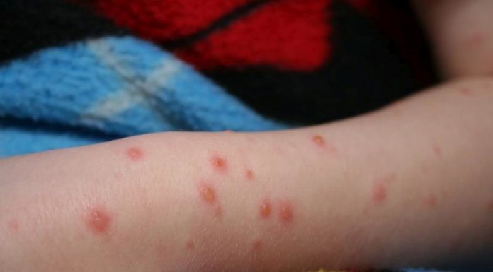 Rafila: Epidemia de rujeolă evoluează în continuare în România