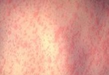 Încă 12 cazuri de rujeolă, confirmate în ultima săptămână