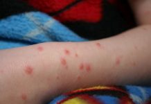 Încă 26 de cazuri de rujeolă, confirmate într-o săptămână