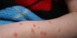 Încă 26 de cazuri de rujeolă, confirmate într-o săptămână