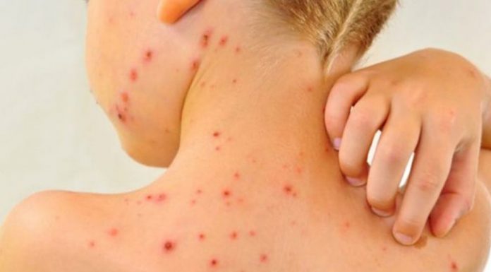 România a depășit 20.000 de cazuri de rujeolă