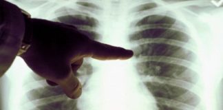 195 de gorjeni, diagnosticați cu TBC