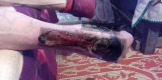 Asistenții comunitari din Albeni, din neștiință, fac pe doctorii! Ei tratează, la domiciliu, piciorul cangrenat al unui localnic