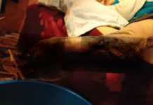 Bolnava fotografiată cu piciorul cangrenat a decedat! Primăria Albeni și DSP Gorj o anchetează pe asistenta medicală comunitară, care și-a încălcat atribuțiile de serviciu