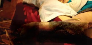 Bolnava fotografiată cu piciorul cangrenat a decedat! Primăria Albeni și DSP Gorj o anchetează pe asistenta medicală comunitară, care și-a încălcat atribuțiile de serviciu