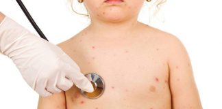 Cazuri noi de rujeolă. Gorjul, pe listă!