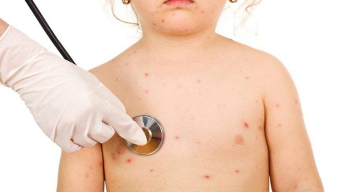 Cazuri noi de rujeolă. Gorjul, pe listă!