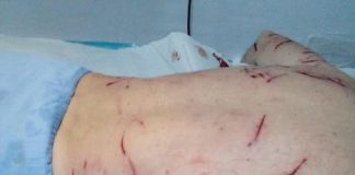 Miner desfigurat de câinii fără stăpân din Valea Jiului!