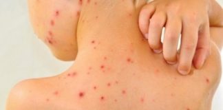 DSP Gorj face lumină: Sunt 53 de cazuri de varicelă în Târgu-Jiu şi Runcu!