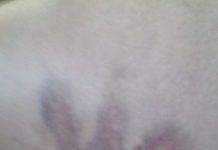 Și-a rupt două coaste, s-a umplut de vânătăi și și-a distrus bicicleta electrică din cauza unor câini din Turburea! Autoritățile au refuzat să o ajute