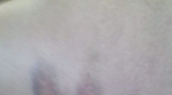 Și-a rupt două coaste, s-a umplut de vânătăi și și-a distrus bicicleta electrică din cauza unor câini din Turburea! Autoritățile au refuzat să o ajute