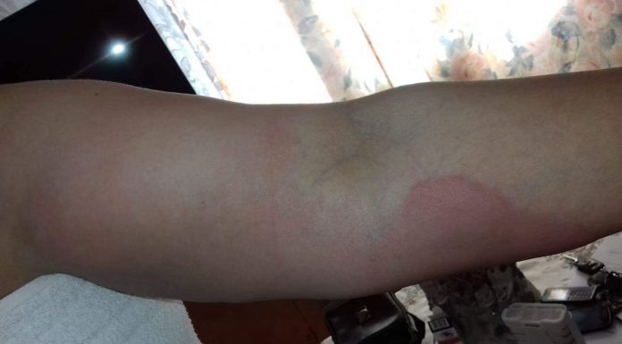 Secretara viceprimarului Aurel Popescu, afectată de un dezinfectant folosit în primărie