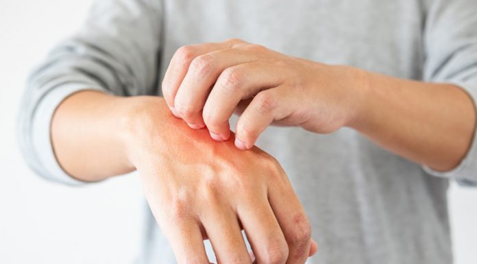 Se poate trata psoriazisul?