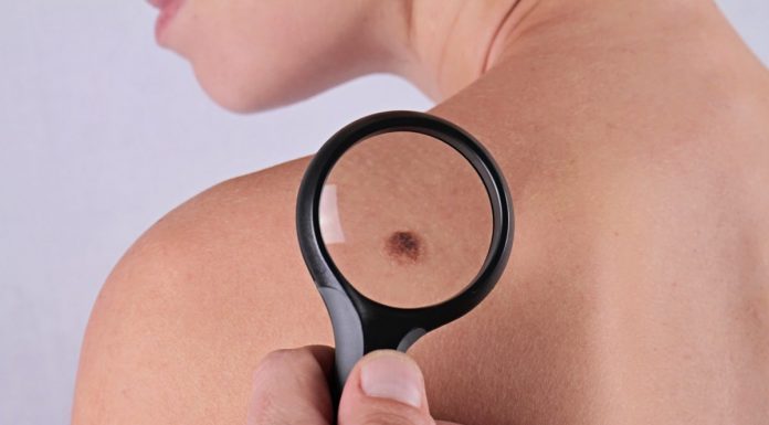 Dermatolog: Cancerele de piele le întâlnim destul de des. Atunci când o aluniță ridică un semn de întrebare, mergeți la medic!
