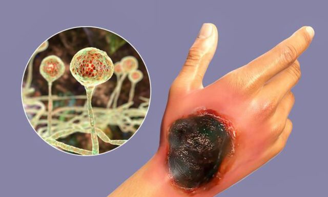 Un alt pericol! Ciuperca neagră la pacienții post-Covid