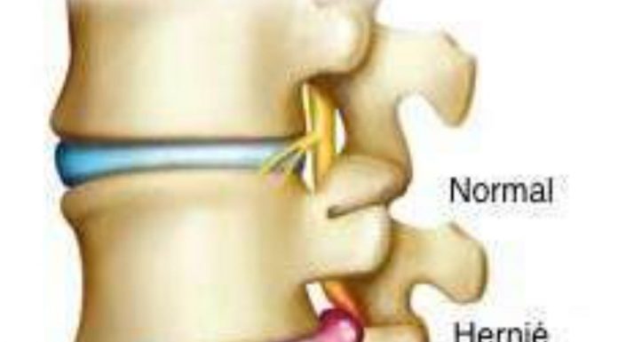 Sfaturi pentru prevenirea herniei de disc