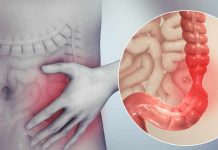 Colonul iritabil, patologie funcțională cu mare răspândire în populație