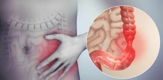 Colonul iritabil, patologie funcțională cu mare răspândire în populație