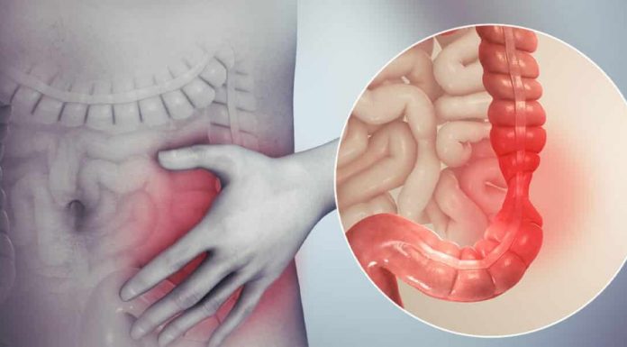 Colonul iritabil, patologie funcțională cu mare răspândire în populație