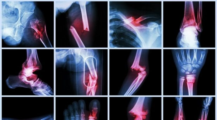 Tipuri de fracturi – cauze și tratament