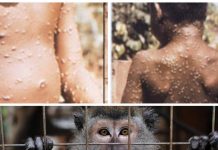 Ministerul Sănătății, informații despre variola maimuței