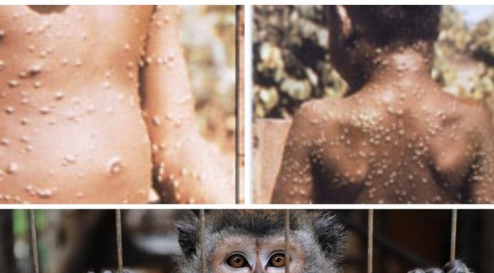 Ministerul Sănătății, informații despre variola maimuței