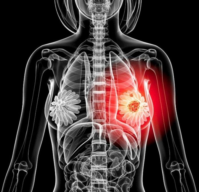 Circa 1.500 de cazuri de cancer mamar, anul trecut, în Gorj