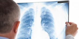 Caravană mobilă pentru depistarea tuberculozei în 11 comune din Gorj