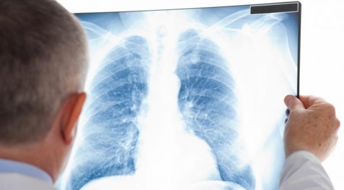 Caravană mobilă pentru depistarea tuberculozei în 11 comune din Gorj