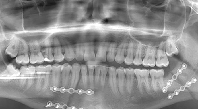 S-a prezentat la Poliția Motru cu maxilarul spart și cu Petcu Jr. urmărindu-l cu un cuțit