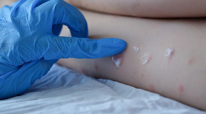 Variola maimuței alarmează epidemiologii – Primul caz și în țara vecină, Ungaria
