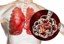 Pneumonia pneumococică – cauze, simptome, tratament