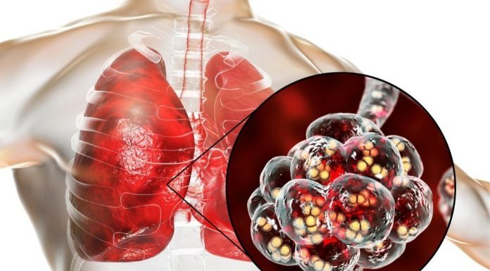 Pneumonia pneumococică – cauze, simptome, tratament