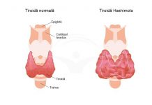 Totul despre tiroidita Hashimoto: cauze, factori de risc, simptome și tratament