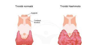 Totul despre tiroidita Hashimoto: cauze, factori de risc, simptome și tratament