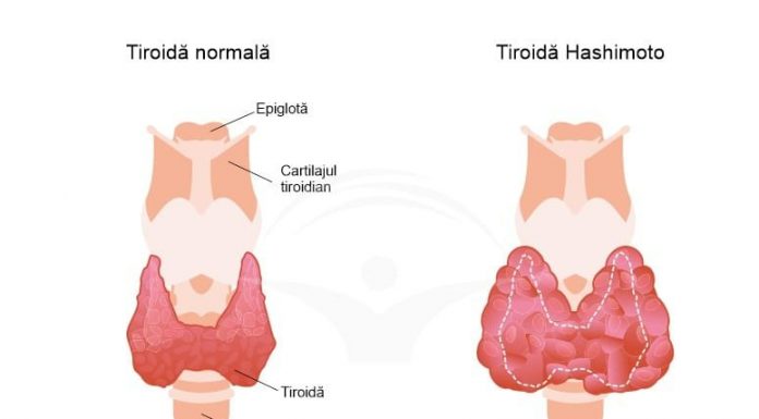 Totul despre tiroidita Hashimoto: cauze, factori de risc, simptome și tratament
